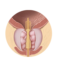 柱状水囊前列腺扩裂导管